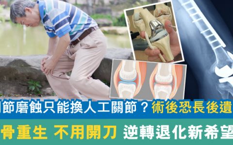 人工膝關節